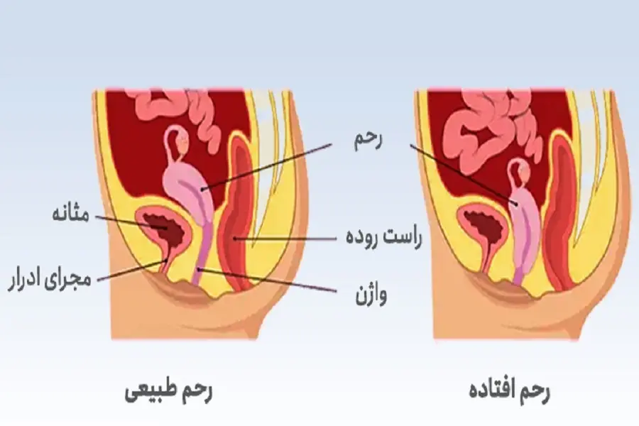 افتادگی رحم