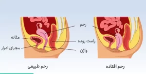 افتادگی رحم