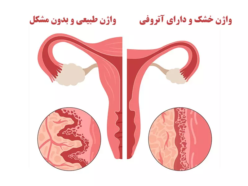 درمان خشکی واژن در خانم ها دکتر لیلا جعفری