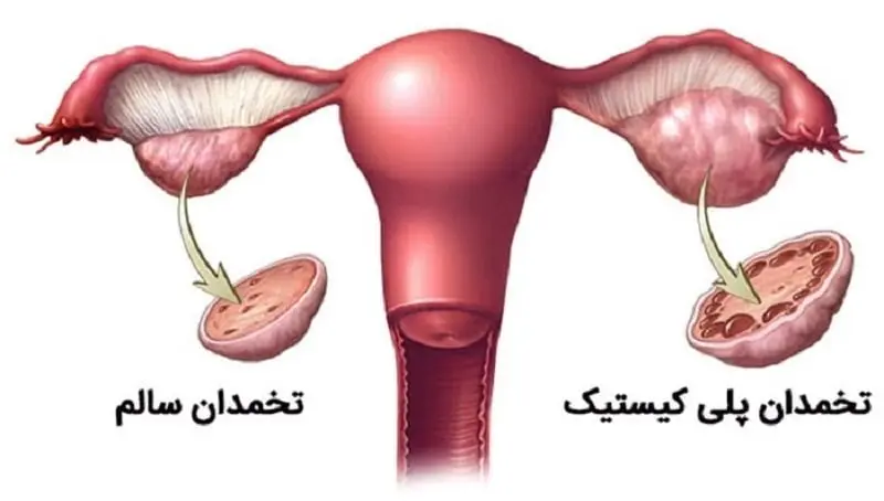 تخمدان پلی کیستیک دکتر لیلا جعفری متخصص زنان و زایمان بوشهر