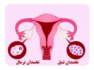تنبلی تخمدان دکتر لیلا جعفری بهترین متخصص زنان