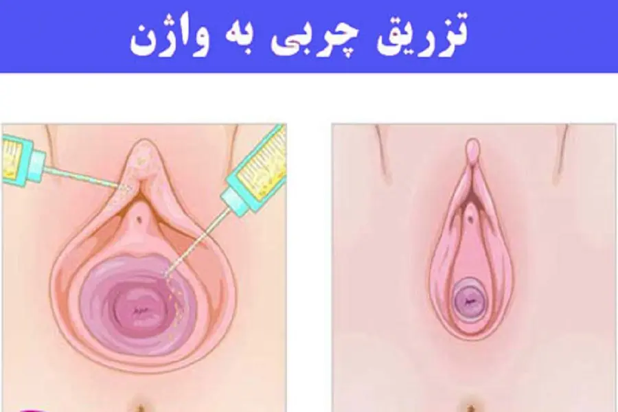 تزریق چربی به ناحیه تناسلی زنان