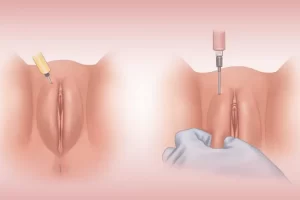 تزریق ژل به واژن توسط دکتر لیلا جعفری
