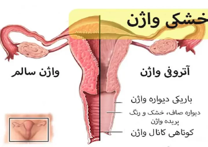 علائم خشکی واژن در خانم ها