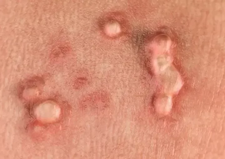 زگیل تناسلی بوشهر