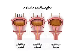 بی اختیاری ادرار