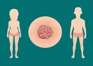 زگیل تناسلی